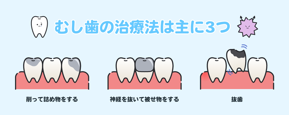 むし歯の治療法は主に3つ