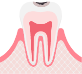 C1エナメル質内の虫歯