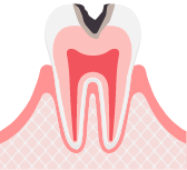 C2象牙質内の虫歯