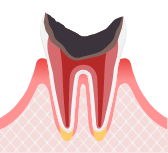 C4歯根に達した虫歯