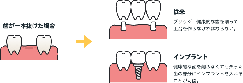 従来の治療とインプラントの違いについて