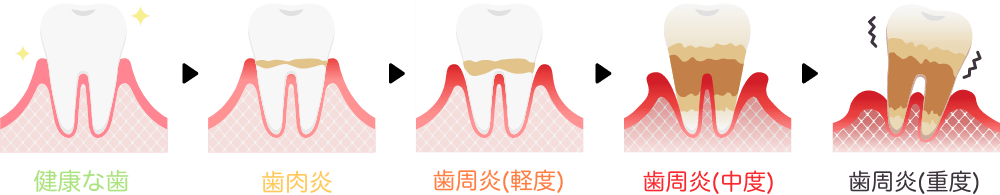 歯周病の進行度